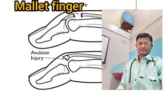 physiotherapy treatment for Finger at home [upl. by Laforge]