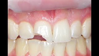 Fix a Chipped or broken tooth at home cheap [upl. by Conlin]