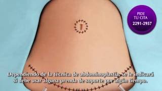 Abdominoplastia  Clínica Thüel [upl. by Suilienroc]