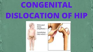 congenital dislocation of hip  PT ortho [upl. by Manup983]