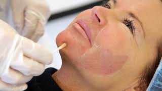 Renew Clinic fenol en tca peeling [upl. by Betthezul802]