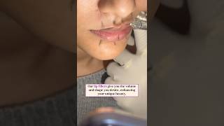 Lip Fillers  Dr Priyanka Aggarwal  Reincarnation Skin Clinic lipfiller liptreatment [upl. by Norma778]