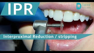 IPR 🪚🦷 Interproximal Reduction  stripping [upl. by Autrey]