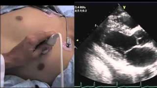 Echocardiography How to Find a Windowmov [upl. by Kensell]