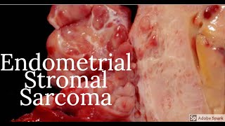 Digital Surgical Pathology 38 Endometrial Stromal Sarcoma [upl. by Lehcyar]