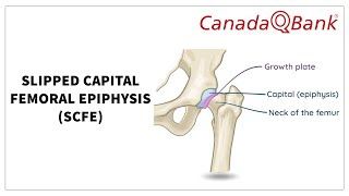 Slipped Capital Femoral Epiphysis SCFE [upl. by Nesta930]