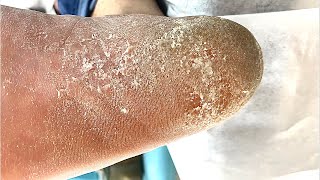 Callus removal from feetampFoot scraping dead skin【Xiao Yan pedicure】stress 21 [upl. by Elayor963]