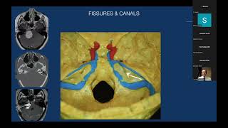 Anatomy and Surgical Approaches to Petrous Bone  Professor Pablo Gonzalez [upl. by Atinaujnas571]