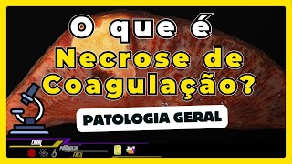 Necrose de coagulação  RESUMO  youtubeshorts [upl. by Irolam]