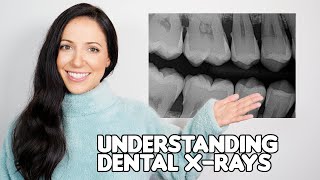 How To Understand Your Dental Xrays Dental Hygienist Explains [upl. by Laen457]