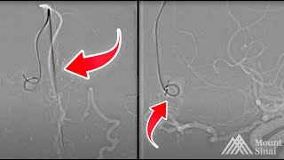 Anterior Ethmoidal Fistula Transvenous Balloon Assisted Approach [upl. by Aracal]