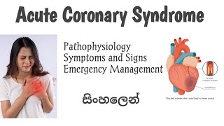 Acute Coronary Syndrome  ACS  Heart attack  සිංහලෙන් [upl. by Webber]