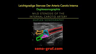 Duplexsonographie  Leichtgradige Stenose Der Arteria Carotis Interna [upl. by Eikkin]