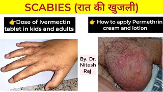 Scabies infection खाज treatment and Head lice जू treatment by Dr Nitesh Raj [upl. by Yarled863]