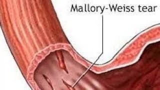 A tell of 2 Brothers Tear of Esophagusছিঁড়ে যাওয়া গ্রাসনালীর গপ্পো Boerhaave Vs Mallory Weiss [upl. by Nnodnarb816]