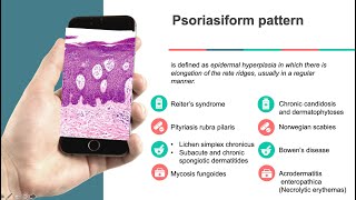 Dermatopathology Psoriasiform reaction pattern [upl. by Eelsha942]