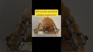 Miniscrew assisted palatal expansion dentist miniscrew manavgatdentist side [upl. by Asiilanna]