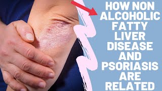 How Non Alcoholic Fatty Liver Disease And Psoriasis Are Related  Weird Connection [upl. by Iline]