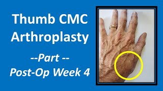 Thumb CMC Arthroplasty Part 4 PostOp Week 4 cmc [upl. by Derina]