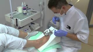 Podoexpert  Lesson2  Toenail Improperly Clipped [upl. by Kask]