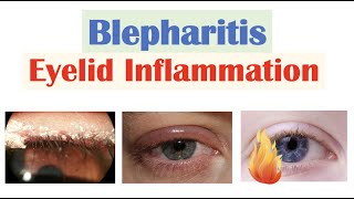 Blepharitis Eyelid Inflammation  Causes Risk Factors Signs amp Symptoms Diagnosis Treatment [upl. by Labana]