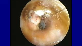 Fungal Ear Infection [upl. by Enos]