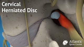 Cervical Herniated Disc [upl. by Reemas]