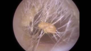 237  Dry Blocked Ear Wax Removal from Hairy Ear using Endoscopic Ear Microsuction [upl. by Aisac]