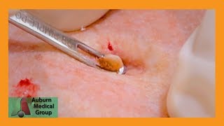 Dilated Pore of Winer Corn Feat Dr Gawayne  Auburn Medical Group [upl. by Bobinette]