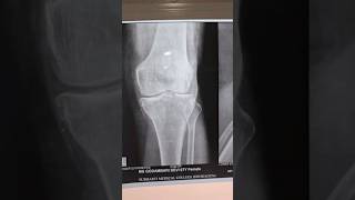 osteoarthritis knee Xray doctor osteoarthritisoftheknee osteoarthritis [upl. by Atalee217]