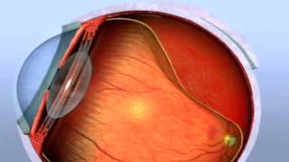 CIRURGIA DO DESCOLAMENTO DE RETINA [upl. by Lanie385]