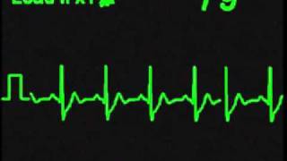 ST Segment Depression  ECG Simulator  Arrhythmia Simulator [upl. by Nolaj361]