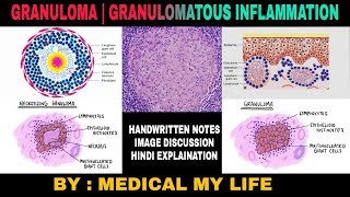 GRANULOMA  GRANULOMATOUS INFLAMMATION  Types Of Chronic Inflammation [upl. by Evaleen]