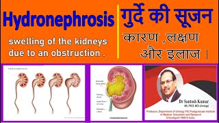 Obstruction in Kidney गुर्दे के रास्ते में रुकावट  Hydronephrosis DrProfSantosh Kumar PGI [upl. by Michelle]