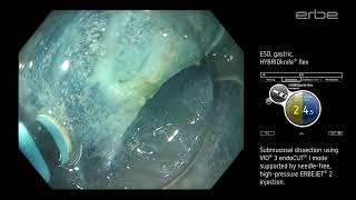 Endoscopic submucosal dissection ESD for stomach neoplasia using HYBRIDknife® flex IType [upl. by Nywg]