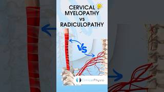 Cervical Radiculopathy vs Myelopathy physiotherapy physicaltherapy medical [upl. by Rahmann812]