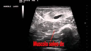 Muscolo gastrocnemio destro lesione gemello laterale [upl. by Malloy]