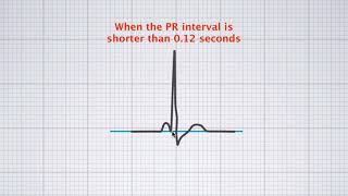 Interpreting ECG duration [upl. by Yseulta850]