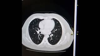 Chronic hepatic parenchymal disease HCCPulmonary metastases Horseshoe kidneys [upl. by Imef304]