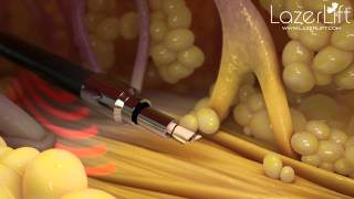 LazerLift  The Minimally Invasive Laser Facelift [upl. by Agamemnon]