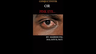 CONJUCTIVITIS II PINK EYE II SEVERE INFECTION [upl. by Adnoryt]