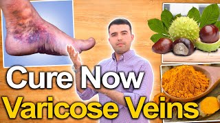 ELIMINATE VARICOSE VEINS NATURALLY  No More Varicose Veins and Leg Pain [upl. by Iturhs]