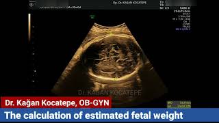 How is the fetal weight of your baby calculated with ultrasound which measurements are necessary [upl. by Ykvir]