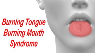 Burning Tongue and Burning Mouth Syndrome Causes and Treatment [upl. by Natassia]