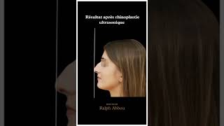 Résultat 1 semaine après rhinoplastie ultrasonique par Dr Abbou [upl. by Drais]