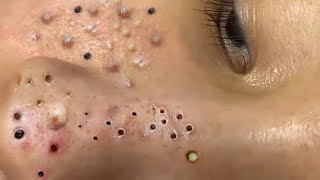 Big Cystic Acne Blackheads Extraction Blackheads amp Milia Whiteheads Removal Pimple Popping  5289 [upl. by Antons]