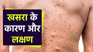 खसरा क्यों होता है  खसरा के कारण और लक्षण  Measles Symptoms  Boldsky health [upl. by Euginom]