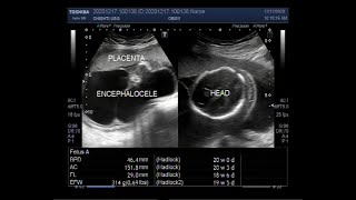 Two large Encephaloceles Hydrops fetalis pericardial effusion ascites and soft tissue edema [upl. by Frances]