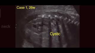 Ultrasound of neuroblastoma [upl. by Ladnyc426]