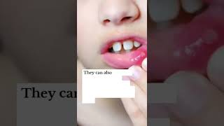 Mouth Ulcers Canker Sore mouthulcer cankersores dentistry oralcare oralhealth dentalhealth [upl. by Auhsohey]